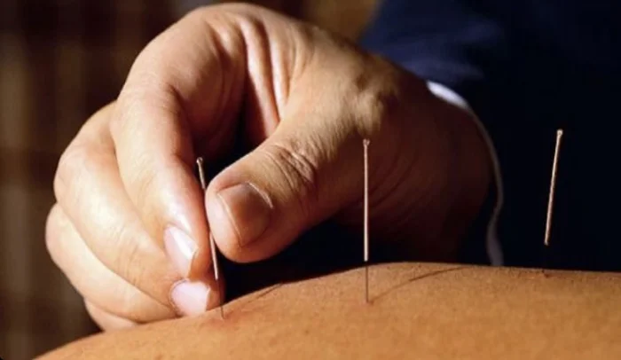 طب سوزنی بر کاهش درد و بهبود عملکرد در بیماران مبتلا به بیرون‌زدگی دیسک گردن