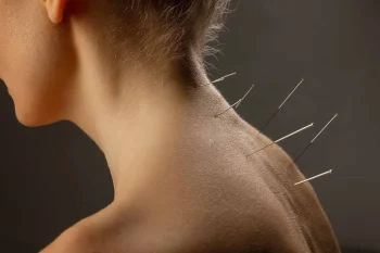 طب سوزنی راهکار قطعی برای درمان گرفتگی‌های مزمن گردن و شانه