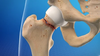 فیزیوتراپی شکستگی لگن