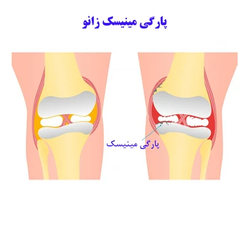فیزیوتراپی پارگی مینیسک زانو