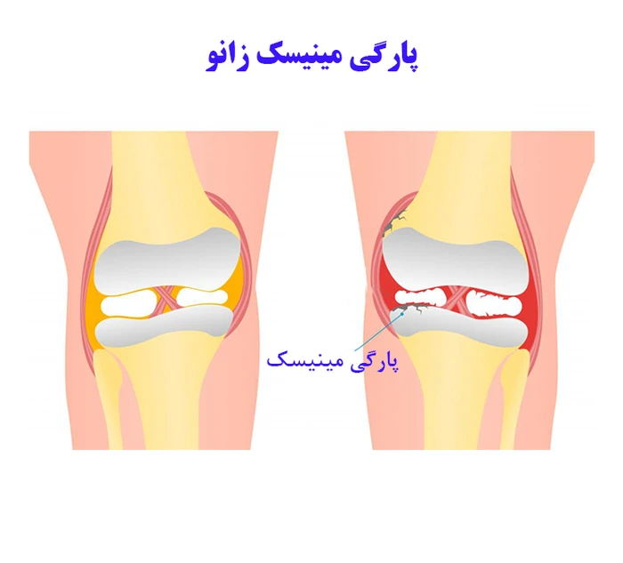 فیزیوتراپی پارگی مینیسک زانو